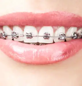 Can You Smoke Weed with Braces?