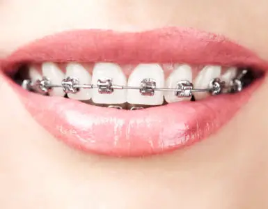 Can You Smoke Weed with Braces?